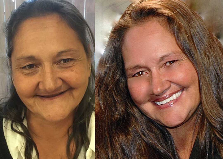 Allday Secure Hammasproteesiliima