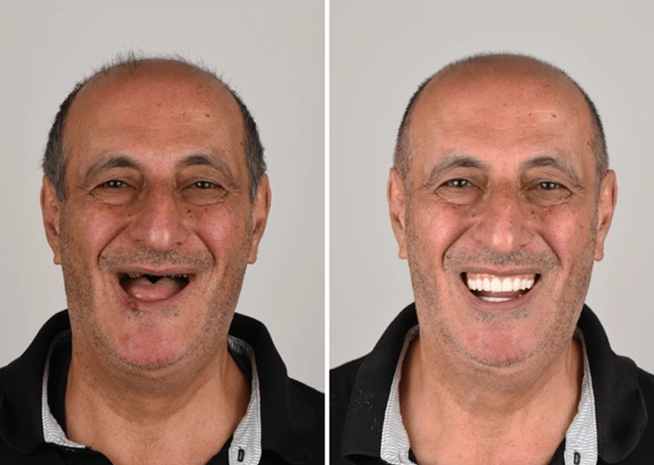 Allday Secure Hammasproteesiliima