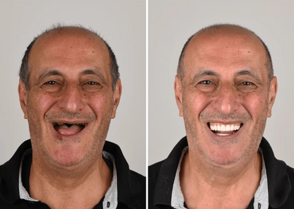 Allday Secure Hammasproteesiliima