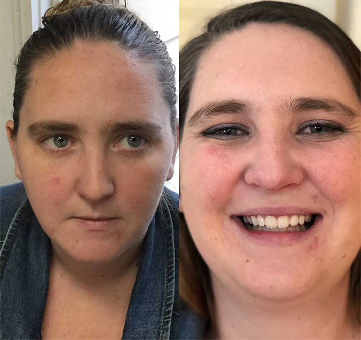 Allday Secure Hammasproteesiliima