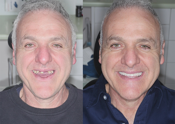 Allday Secure Hammasproteesiliima